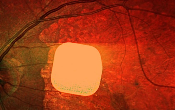 Британские врачи частично восстановили зрение пациентам с помощью микрочипа